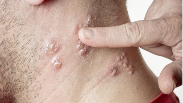 猴痘和水痘-带状疱疹的皮疹如何鉴别？